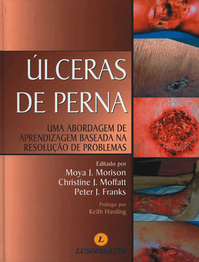 Úlceras de Perna