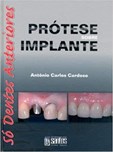 Prótese Sobre Implante - Só Dentes Anteriores
